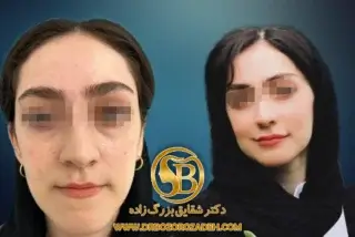 جراحی ادونسمنت ماگزیلا، ست‌بک مندیبل و جنیوپلاستی برای بهبود عملکرد و زیبایی در قایمشهر.