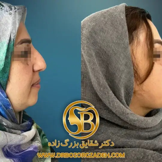 نتایج جراحی ادونسمنت چانه و بینی به روش Preservation در قایمشهر.