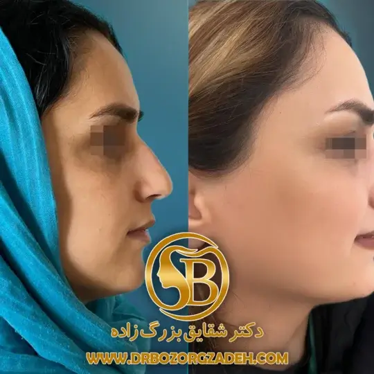 جراحی بینی به روش پرزرویشن برای اصلاح فرم و حفظ جزئیات طبیعی