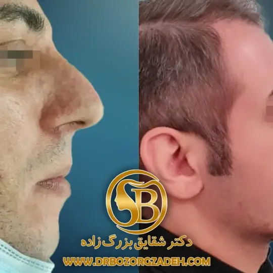 جراحی بینی به روش پرزرویشن برای اصلاح فرم با حفظ ساختارهای اصلی